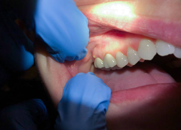 Best Cracked Tooth Emergency Dentist  in Thunderbolt, GA